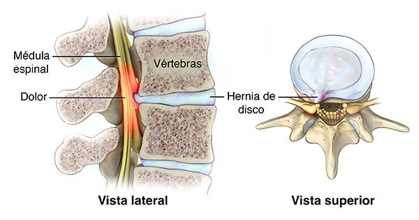 Vista lateral y superior de las vértebras con una hernia de disco.