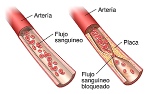 Arteria normal y arteria con acumulación de placa.