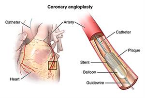 Angioplastia coronaria